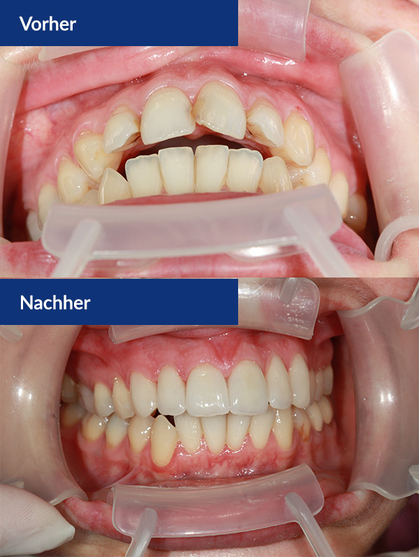 Veneers: Vorher / Nacher Abbildung