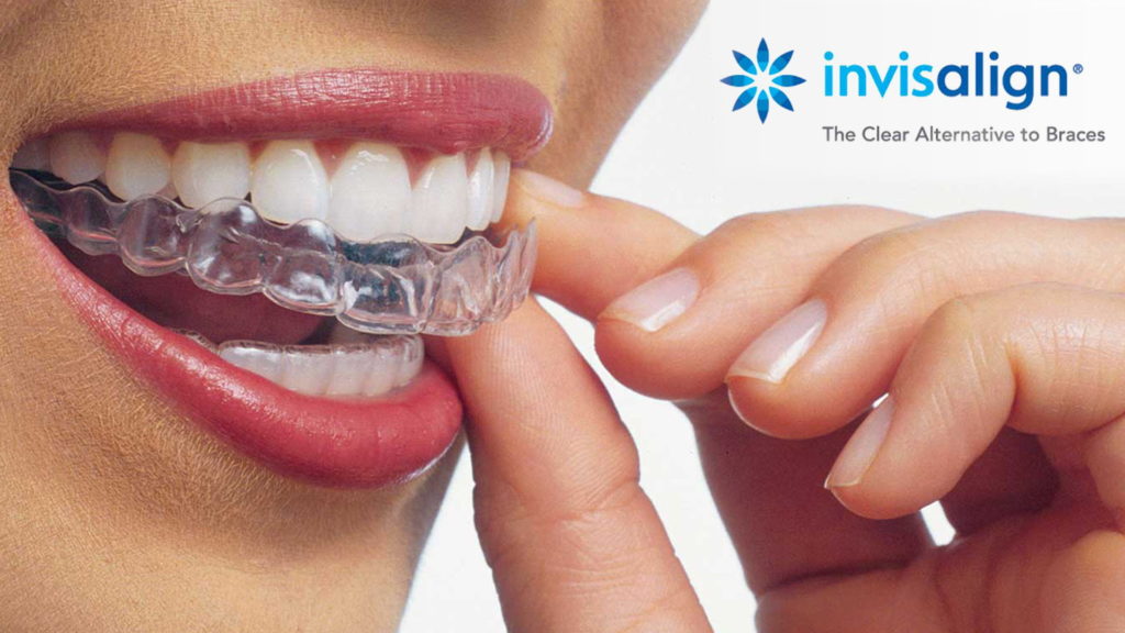 Invisalign